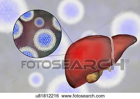 Stock Photograph - Hepatitis C, illustration. Fotosearch