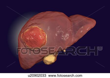 Liver cancer, illustration View Large Photo Image Stock Image - Liver cancer, illustration. Fotosearch