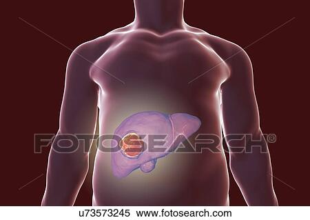 Stock Photography - Liver cancer, illustration. Fotosearch