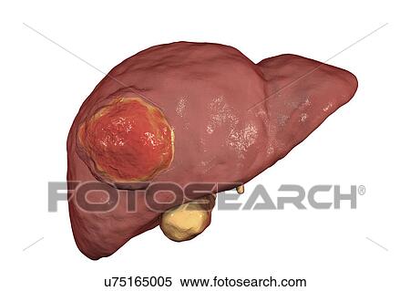Liver cancer, illustration View Large Photo Image Stock Photography - Liver cancer, illustration. Fotosearch