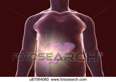 Stock Image - Liver cancer treatment, conceptual illustration. Fotosearch