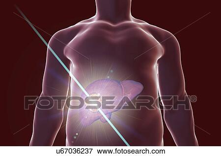 Stock Photo - Liver cancer treatment, conceptual illustration. Fotosearch