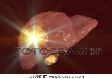 Liver cancer treatment, conceptual illustration View Large Photo Image Stock Photo - Liver cancer treatment, conceptual illustration. Fotosearch