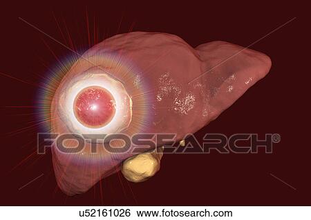 Stock Photograph - Liver cancer treatment, conceptual illustration. Fotosearch