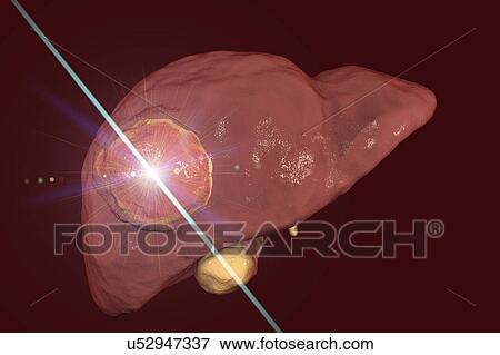Liver cancer treatment with laser, illustration View Large Photo Image Stock Photo - Liver cancer treatment with laser, illustration. Fotosearch