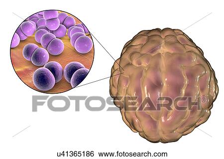 Meningitis caused by bacteria, illustration View Large Photo Image Stock Photograph - Meningitis caused by bacteria, illustration. Fotosearch