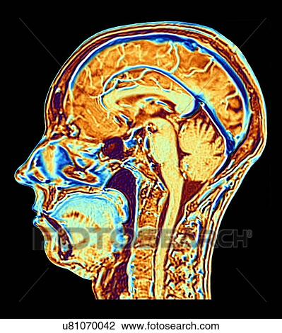 MRI scan of normal brain, artwork View Large Photo Image Stock Image - MRI scan of normal brain, artwork. Fotosearch