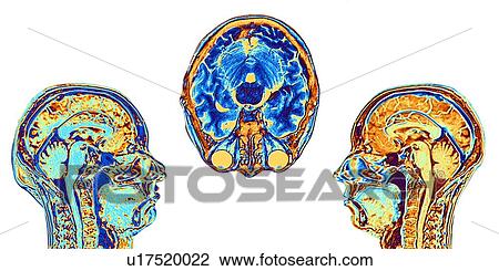 Stock Image - MRI scans of normal brains, artwork. Fotosearch