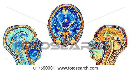 Stock Image - MRI scans of normal brains, artwork. Fotosearch