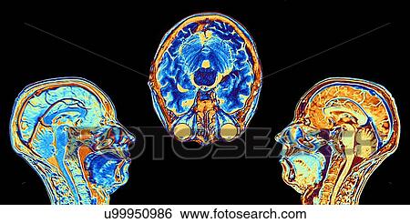 Stock Photograph - MRI scans of normal brains, artwork. Fotosearch