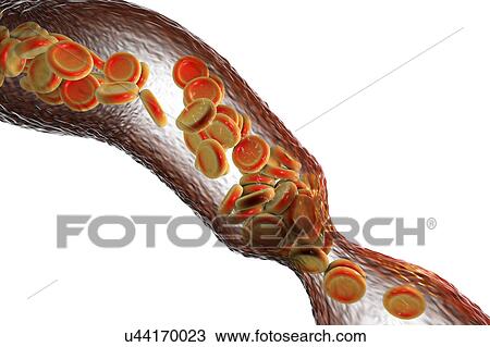 Narrowed blood vessel, illustration View Large Photo Image Stock Image - Narrowed blood vessel, illustration. Fotosearch