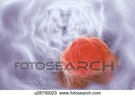 Oesophageal cancer, illustration View Large Photo Image Stock Image - Oesophageal cancer, illustration. Fotosearch