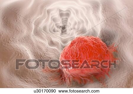 Stock Image - Oesophageal cancer, illustration. Fotosearch