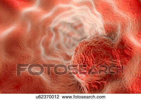 Stock Image - Oesophageal cancer, illustration. Fotosearch