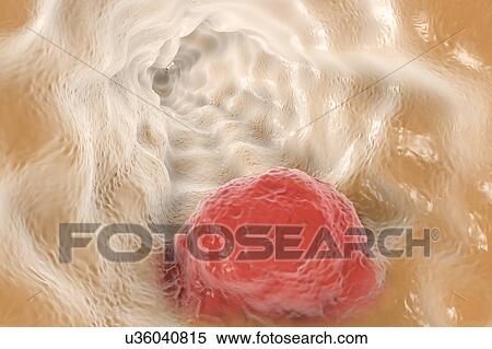 Stock Photography - Oesophageal cancer, illustration. Fotosearch