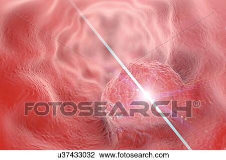 Oesophageal cancer treatment, illustration View Large Photo Image Stock Image - Oesophageal cancer treatment, illustration. Fotosearch