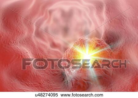 Stock Photography - Oesophageal cancer treatment, illustration. Fotosearch