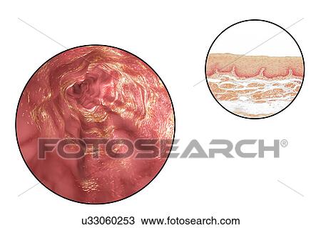 Stock Image - Oesophagus wall, light micrograph and illustration. Fotosearch