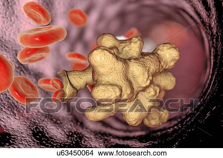 Parasitic amoeba (Entamoeba histolytica), illustration View Large Photo Image Picture - Parasitic amoeba (Entamoeba histolytica), illustration. Fotosearch