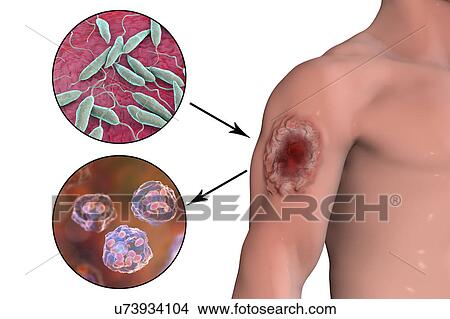 Picture - Skin ulcer in leishmaniosis, illustration. Fotosearch
