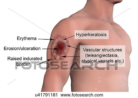 Skin ulcer in leishmaniosis, illustration View Large Photo Image Stock Image - Skin ulcer in leishmaniosis, illustration. Fotosearch