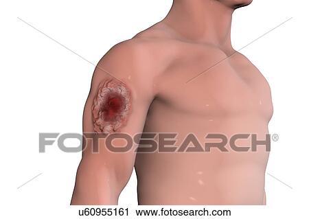 Stock Image - Skin ulcer in leishmaniosis, illustration. Fotosearch