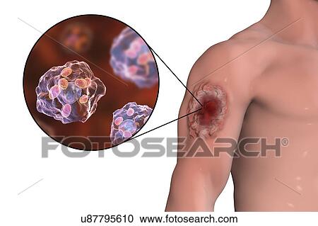 Stock Image - Skin ulcer in leishmaniosis, illustration. Fotosearch