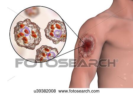 Stock Photo - Skin ulcer in leishmaniosis, illustration. Fotosearch