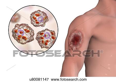 Stock Photo - Skin ulcer in leishmaniosis, illustration. Fotosearch