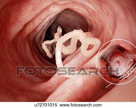 Stock Photography - Tapeworm in human intestine, illustration. Fotosearch