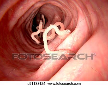 Tapeworm in human intestine, illustration View Large Photo Image Stock Photography - Tapeworm in human intestine, illustration. Fotosearch