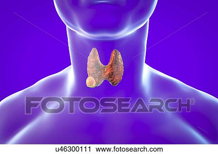 Stock Image - Thyroid gland in a man's neck, illustration. Fotosearch