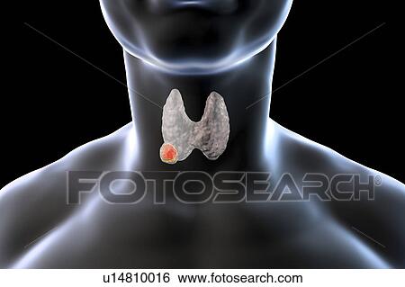 Thyroid gland in a man's neck, illustration View Large Photo Image Stock Photograph - Thyroid gland in a man's neck, illustration. Fotosearch