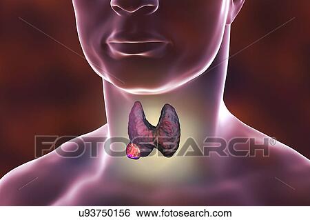 Thyroid gland in a man's neck, illustration View Large Photo Image Stock Photograph - Thyroid gland in a man's neck, illustration. Fotosearch