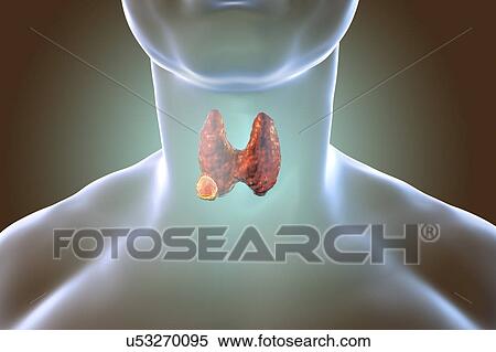 Stock Photography - Thyroid gland in a man's neck, illustration. Fotosearch