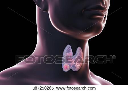 Thyroid gland in a man's neck, illustration View Large Photo Image Stock Photography - Thyroid gland in a man's neck, illustration. Fotosearch