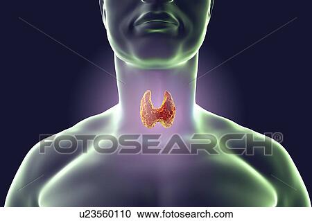 Thyroid gland tumour, artwork View Large Photo Image Stock Image - Thyroid gland tumour, artwork. Fotosearch