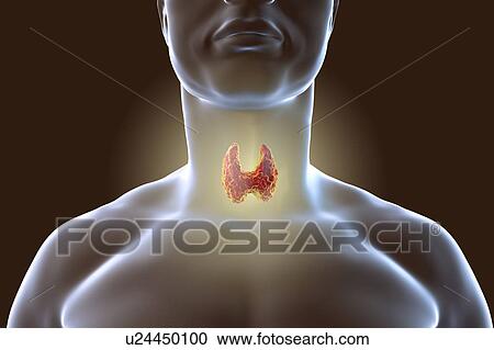 Stock Image - Thyroid gland tumour, artwork. Fotosearch