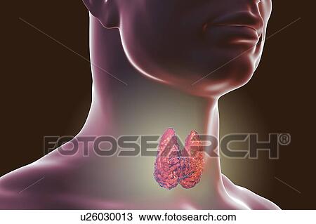 Stock Image - Thyroid gland tumour, artwork. Fotosearch