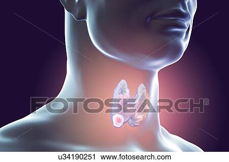 Stock Image - Thyroid gland tumour, artwork. Fotosearch