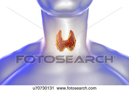 Thyroid gland tumour, artwork View Large Photo Image Stock Image - Thyroid gland tumour, artwork. Fotosearch