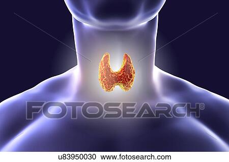 Stock Image - Thyroid gland tumour, artwork. Fotosearch