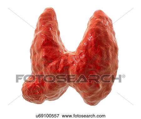 Stock Photo - Thyroid gland tumour, artwork. Fotosearch