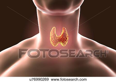 Thyroid gland tumour, artwork View Large Photo Image Stock Photo - Thyroid gland tumour, artwork. Fotosearch