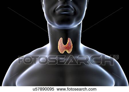 Thyroid gland tumour, artwork View Large Photo Image Stock Photography - Thyroid gland tumour, artwork. Fotosearch