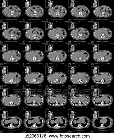 Stock Photograph - Abdomen and chest anatomy, CT scans. Fotosearch