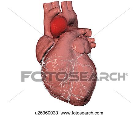 Stock Image - Aortic aneurysm, illustration. Fotosearch
