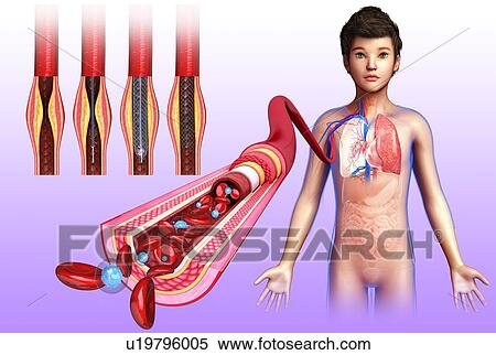 Blocked artery stent treatment, illustration View Large Photo Image Stock Photography - Blocked artery stent treatment, illustration. Fotosearch