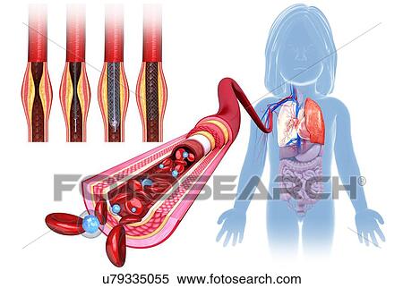 Blocked artery stent treatment, illustration View Large Photo Image Stock Photography - Blocked artery stent treatment, illustration. Fotosearch