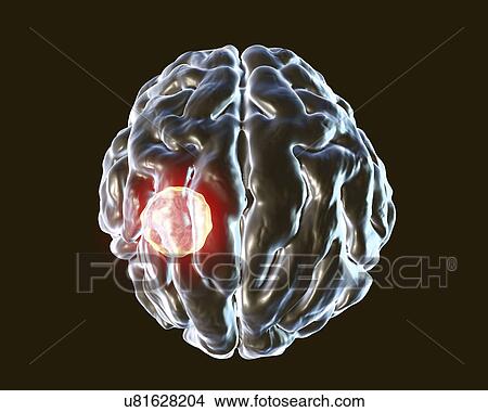 Picture - Brain abscess caused by Toxoplasma gondii, illustration. Fotosearch
